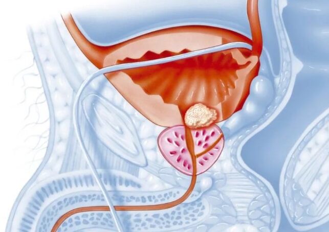 Značilnosti kronične oblike prostatitisa