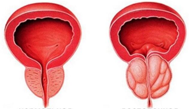 Kronični prostatitis