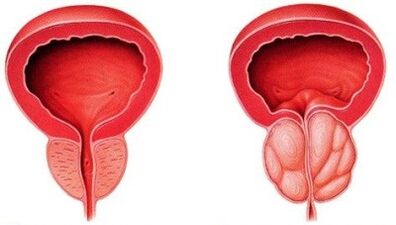 Zdrava in vneta prostata s prostatitisom
